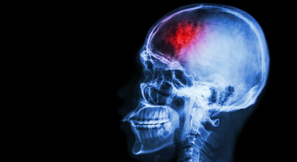 داروهای پوشیده شده از ذرات نانو می توانند به قربانیان سکته مغزی کمک کنند