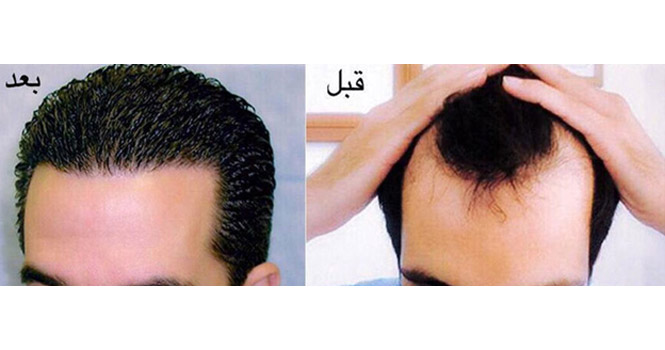 کاشت مو چیست؟ آشنایی با بهترین مرکز کاشت مو در ایران و روش‌های مختلف آن