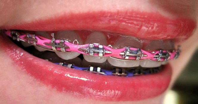 ارتودنسی ثابت و مراحل نصب آن بر دندان ها