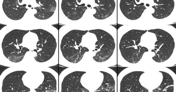 تصاویر سی تی اسکن ریه مبتلا به ویروس کرونا ؛ کووید 19 چه بر سر ریه‌ها می‌آورد؟