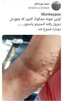 یک پزشک با انتشار عکسی در توییتر خود،‌ از یک مورد مشکوک به آبله میمون در ایران خبر داد.