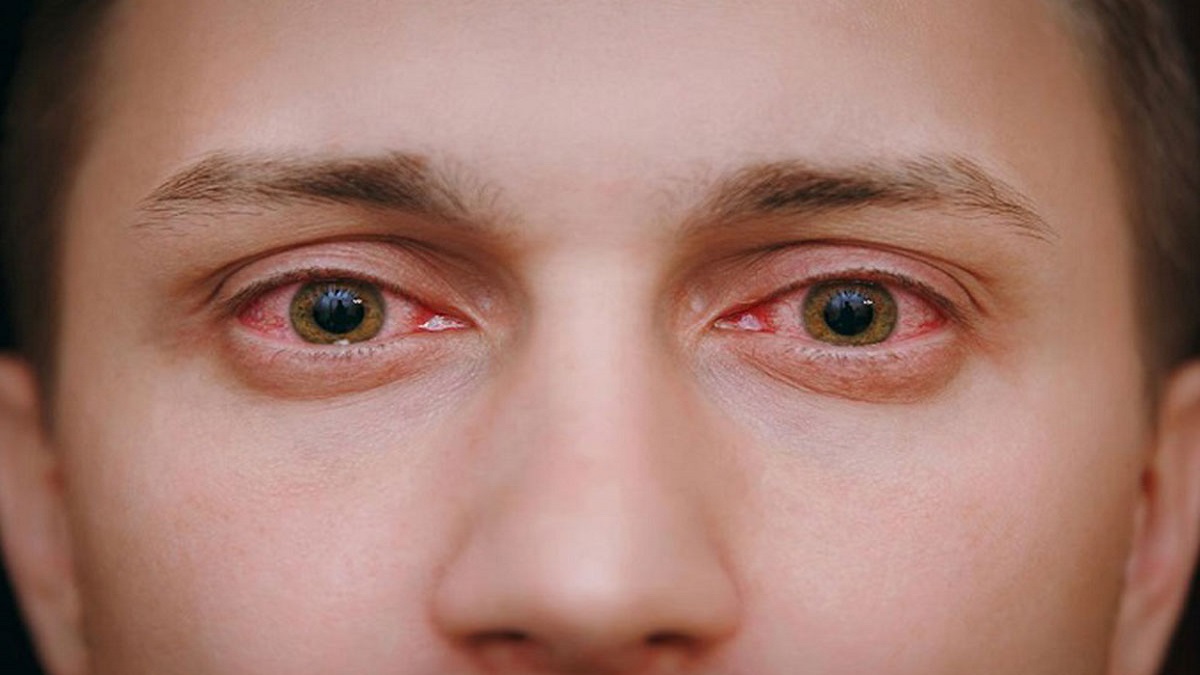 این زیرسویه امیکرون به التهاب ملتحمه چشم منجر می‎‌شود