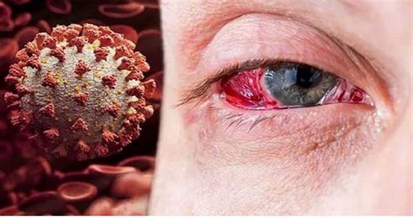 اُمیگرون جدید منجربه به بروز التهاب ملتحمه چشم می‌شود