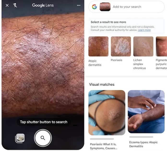 تشخیص مشکلات پوستی با هوش مصنوعی گوگل لنز