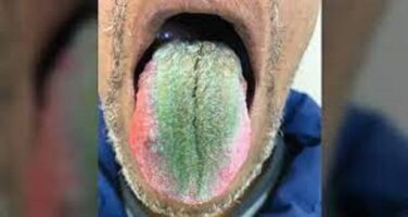 زبان این مرد 64 ساله از مو پوشیده شده است