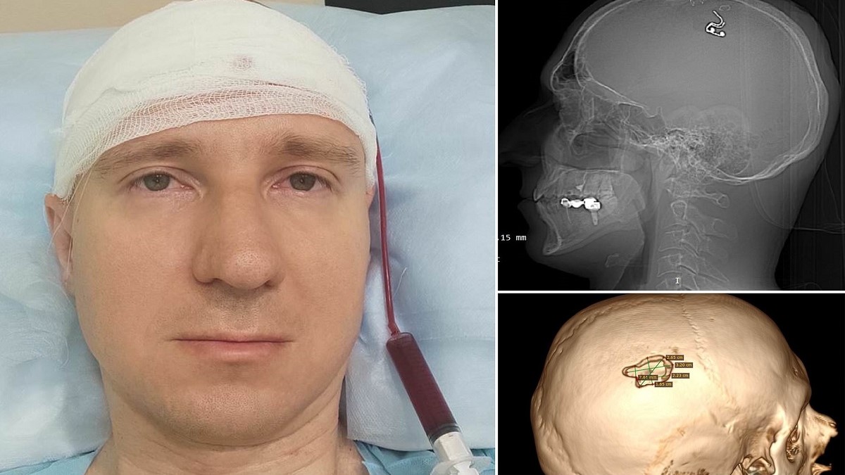 این محقق روسی جمجمه خود را سوراخ کرد و در مغزش تراشه کاشت! [+عکس]