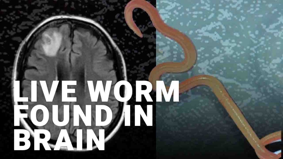 کرم زنده هشت سانتی‌متری در مغز یک زن استرالیایی کشف شد