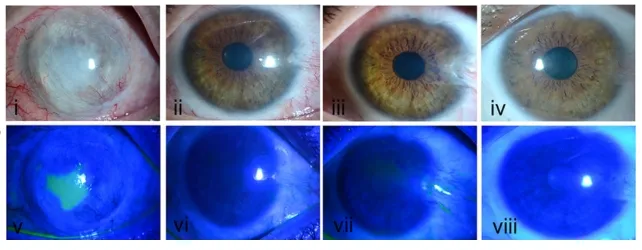 درمان انواع آسیب‌های چشمی با سلول‌های بنیادی میسر شد