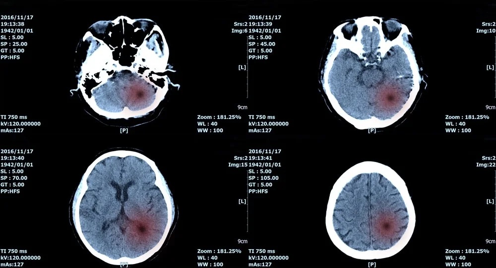 تشخیص نوع تومور مغزی با هوش مصنوعی در عرض 20 دقیقه!