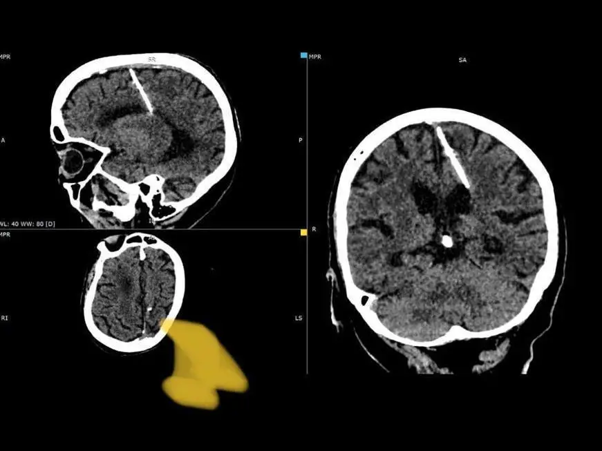 کشف یک سوزن سه سانتی‌متری در مغز پیرزن روس