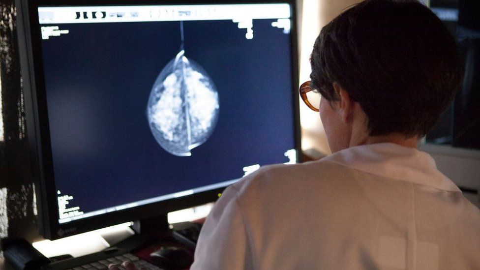 هوش مصنوعی بهتر از پزشکان می‌تواند روند تغییرات سرطان پستان را پیش‌بینی کند