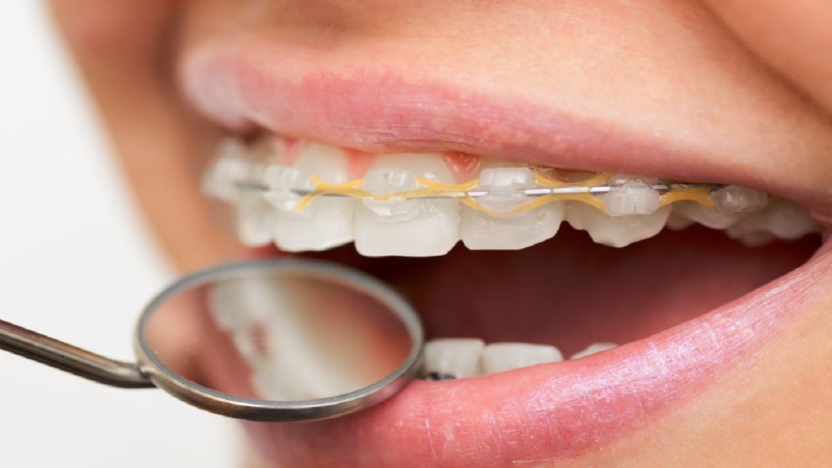 ارتودنسی یک راهکار موثر برای اصلاح ظاهر و عملکرد دندان‌ ها