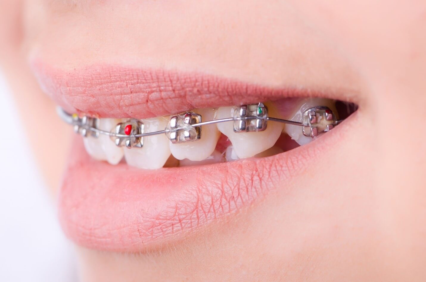 هزینه ارتودنسی دندان چقدر است؟