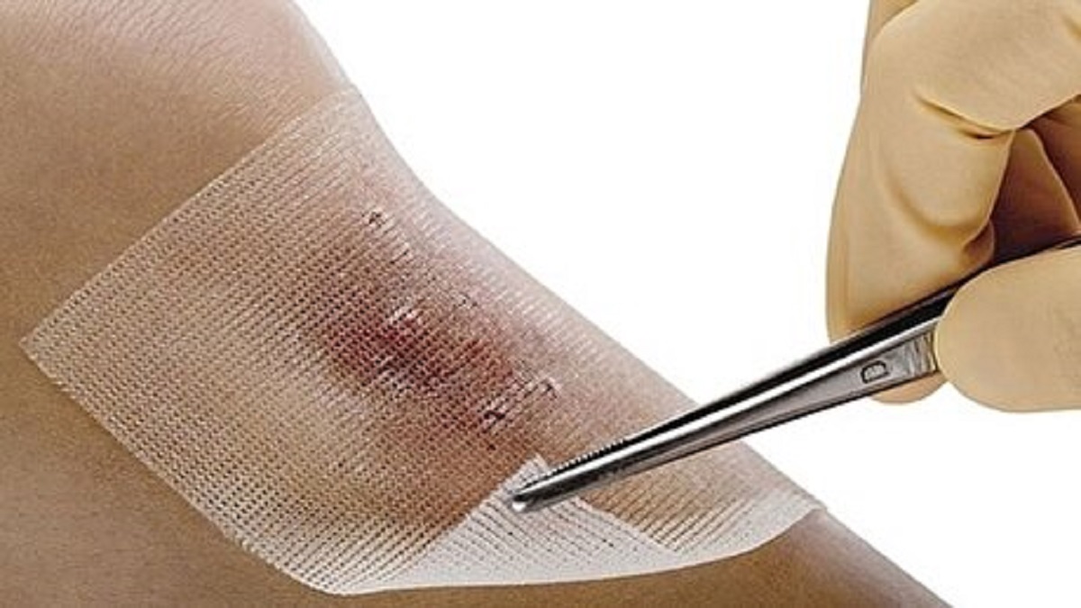 با این پانسمان‌های نانو تولید داخل خونریزی‌های ناشی از جراحات تا 91 درصد کاهش می‌یابد