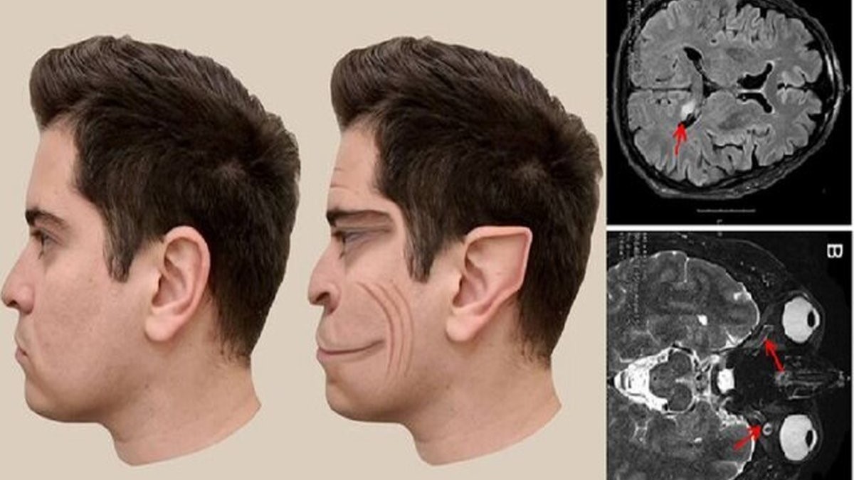 یک بیماری عجیب که چهره انسان را شبیه به فیلترهای تیک تاک می کند [+عکس]