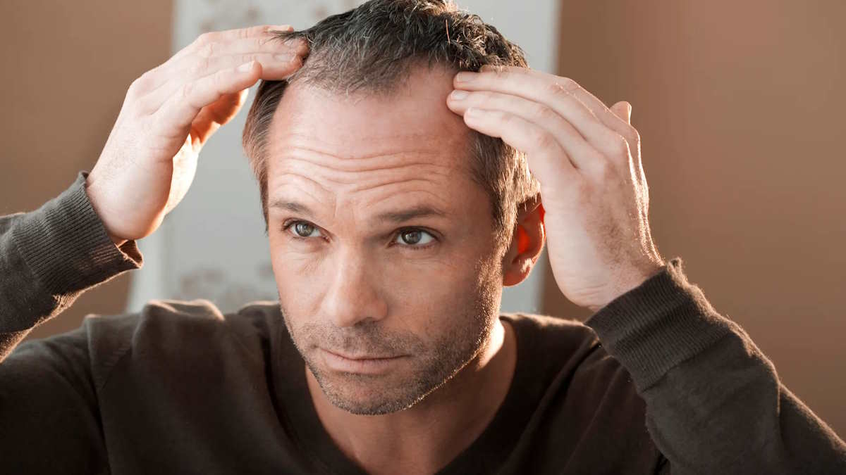 دانشمندان درمان ریزش مو ناشی از آلوپسی کشف کردند