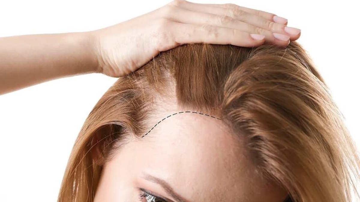 دانشمندان درمان ریزش مو ناشی از آلوپسی را کشف کردند
