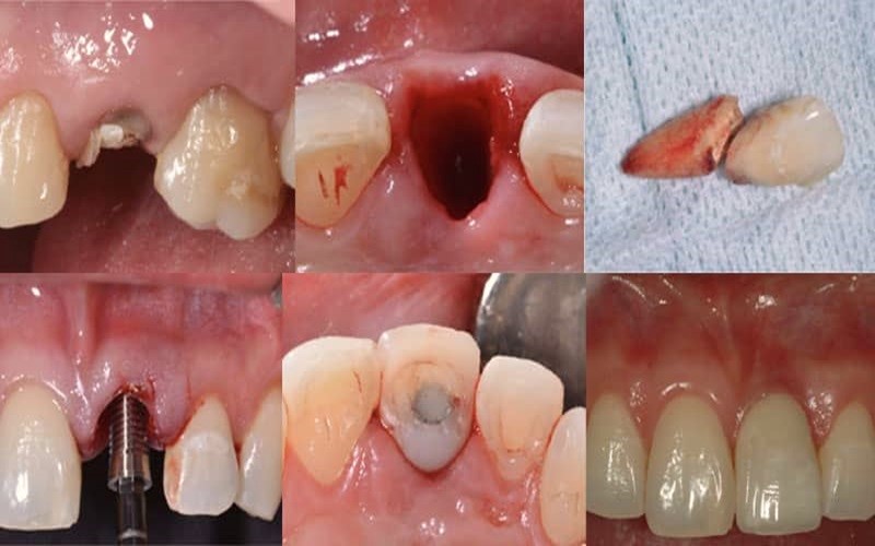 معایب کاشت ایمپلنت بلافاصله بعد از کشیدن دندان